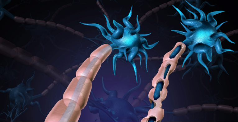 The axon of the neuron, pictured on the right side, begins to degrade following the onset of multiple sclerosis.