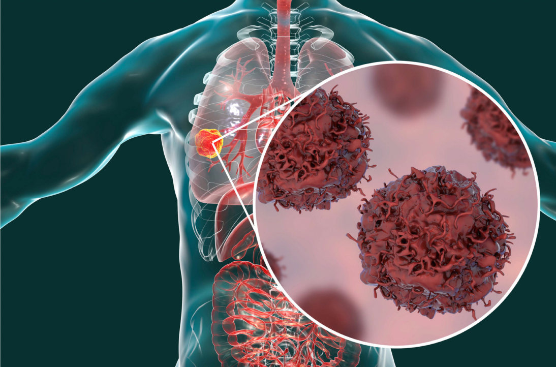 An illustration of lung cancer.
